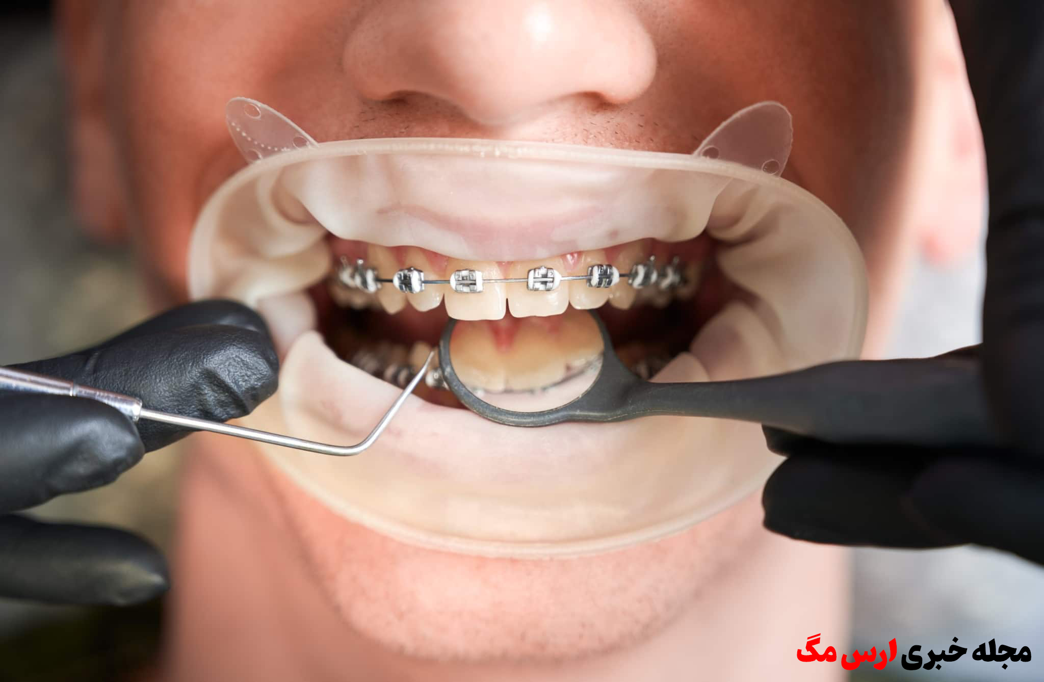 ارس مگ؛ هشدار! التهاب لثه ممکن است مغز شما را بخورد!